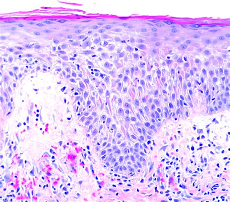 seborrheic dermatitis pathology outlines